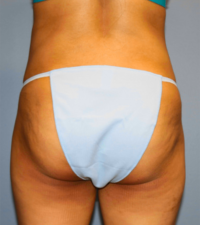 Tummy Tuck