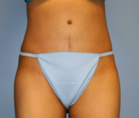 Tummy Tuck