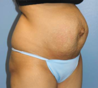 Tummy Tuck