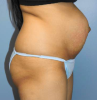 Tummy Tuck