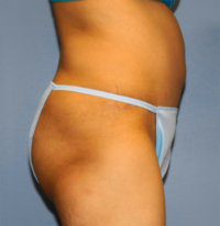 Tummy Tuck