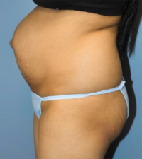 Tummy Tuck