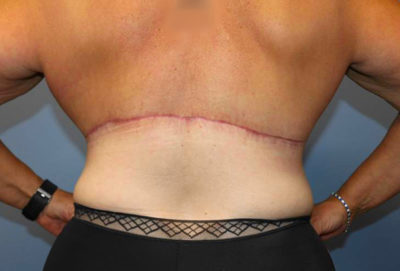 Plastic Surgery Case Study - The Braline Backlift for Removal of Back Rolls  - Explore Plastic Surgery