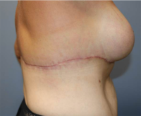 Patient #17574 Bra Line Lift Before and After Photos Pittsburgh