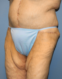 Panniculectomy