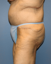 Panniculectomy