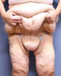 Panniculectomy