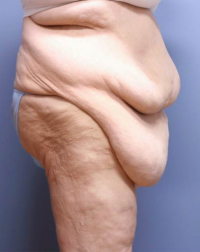 Panniculectomy
