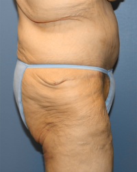 Panniculectomy