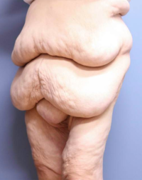 Panniculectomy