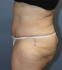 Tummy Tuck