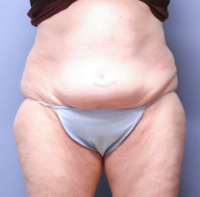 Tummy Tuck