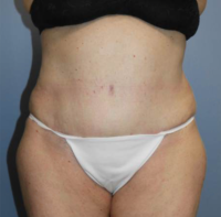 Tummy Tuck