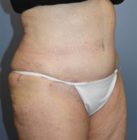 Tummy Tuck