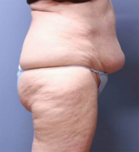 Tummy Tuck