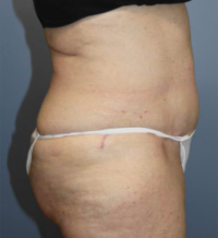 Tummy Tuck