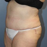 Tummy Tuck