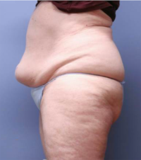 Tummy Tuck