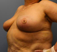 Breast Reduction