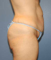 Tummy Tuck