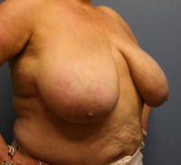 Breast Reduction