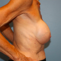 Breast Implant Removal