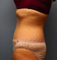 Tummy Tuck