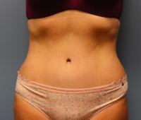 Tummy Tuck