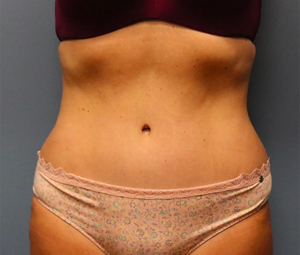 After Tummy Tuck 