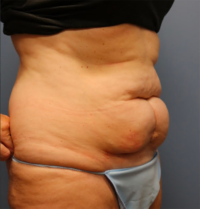 Tummy Tuck