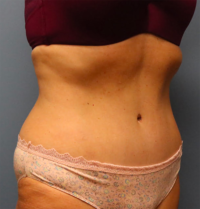 Tummy Tuck