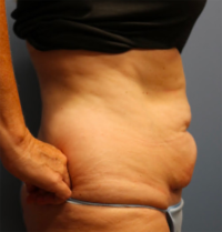 Tummy Tuck