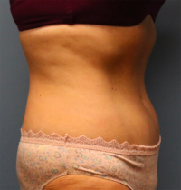 Tummy Tuck