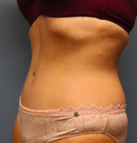 Tummy Tuck