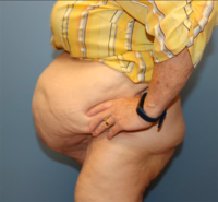 Panniculectomy