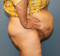 Panniculectomy