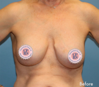 Breast Implant Removal