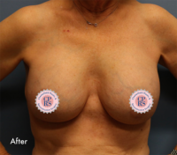 Breast Implant Removal