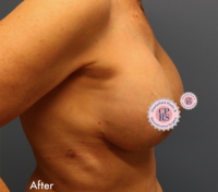 Breast Implant Removal