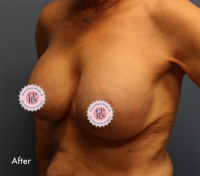 Breast Implant Removal