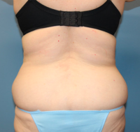 Tummy Tuck