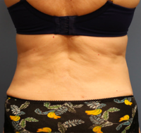 Tummy Tuck