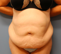 Tummy Tuck