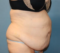 Tummy Tuck