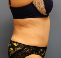 Tummy Tuck