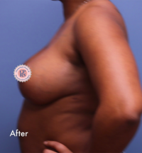 Breast Reduction