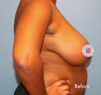 Breast Reduction