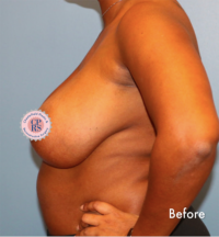 Breast Reduction