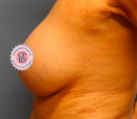 Breast Implant Removal