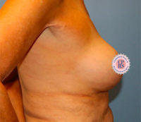 Breast Implant Removal